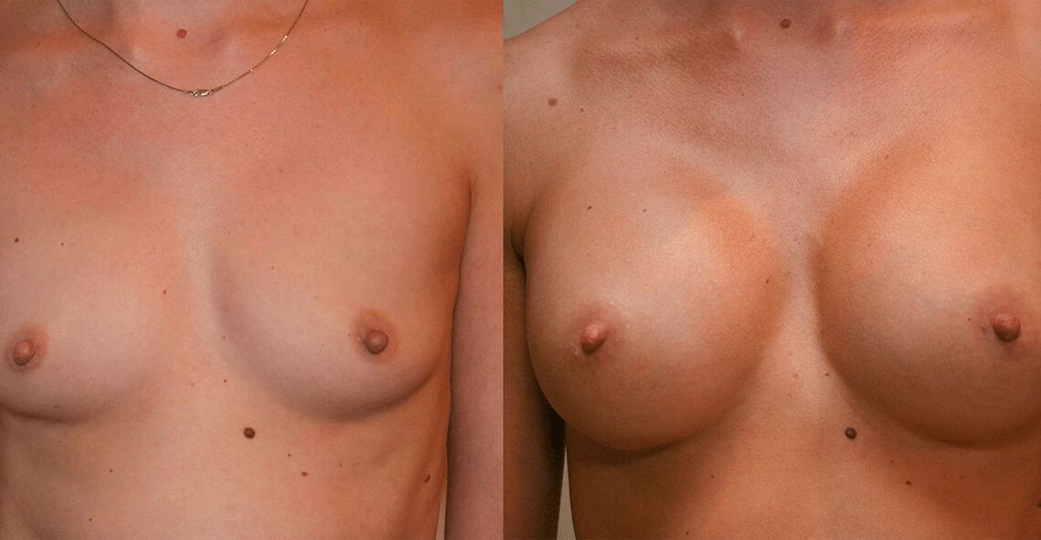 Breast augmentation before and after