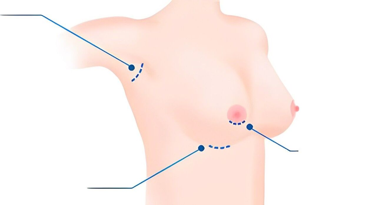 Types of Breast Augmentation Sizes